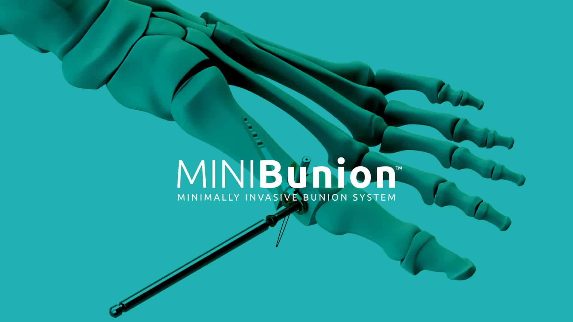 Bunion Surgery Bregman FootAnkle & Nerve Center